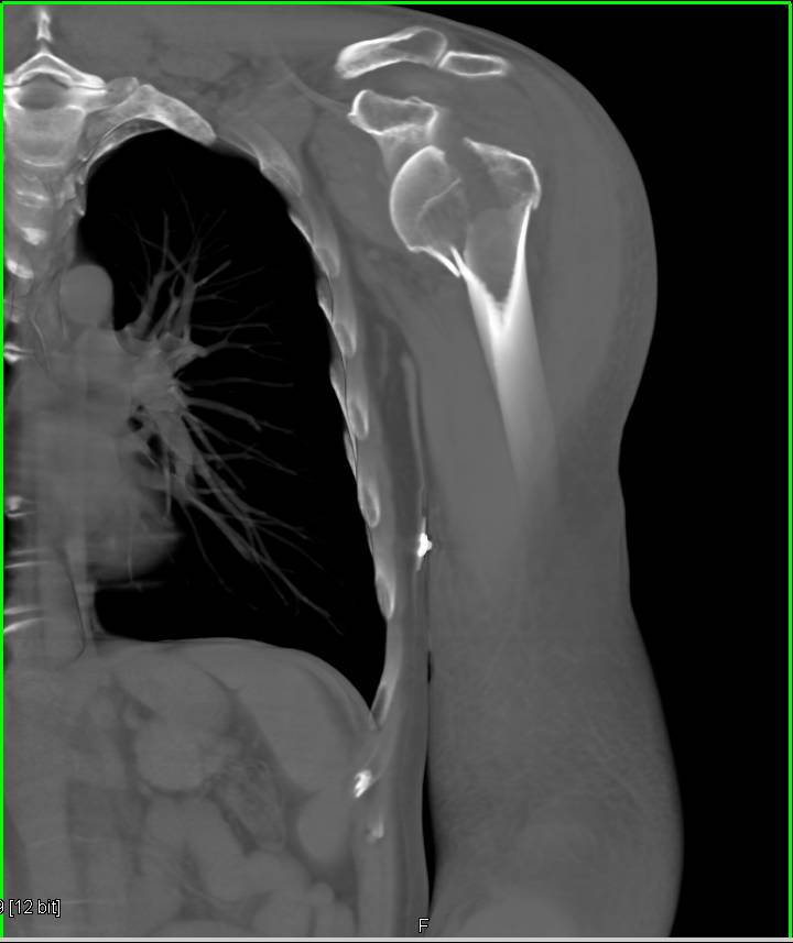 Humerus Fracture with Anterior Dislocation - CTisus CT Scan