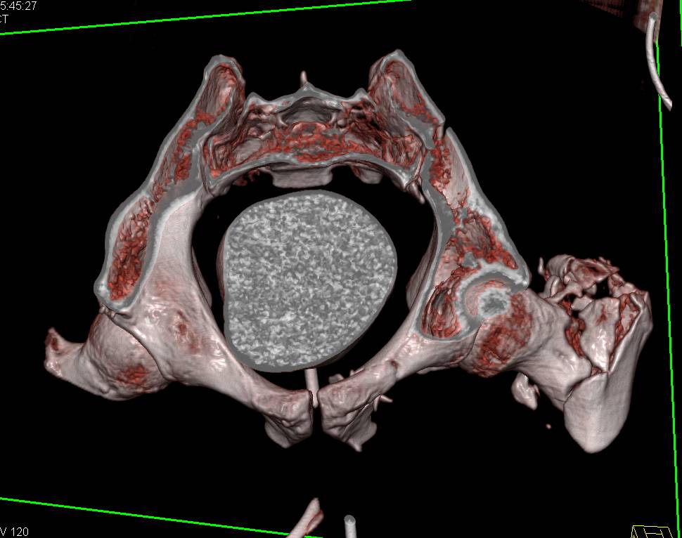 Comminuted Pelvic Fractures without Bladder Injury - CTisus CT Scan