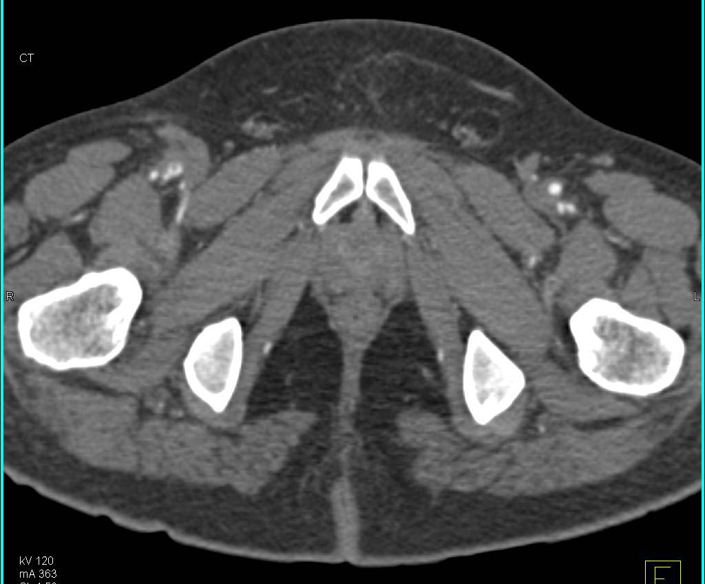 Trauma with Injury to Right Superficial Femoral Artery (SFA) Without Active Extravasation - CTisus CT Scan