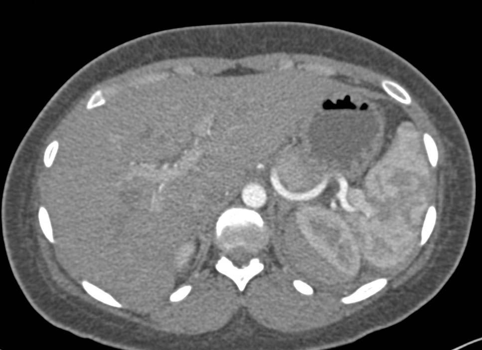 Renal Laceration with Perirenal Bleed - CTisus CT Scan