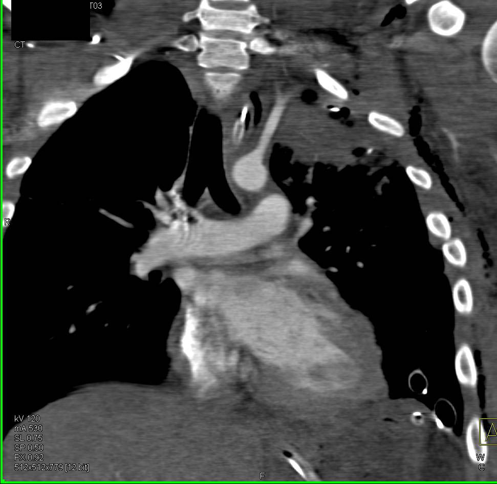 Trauma to Left Upper Chest Without Vascular Injury - CTisus CT Scan