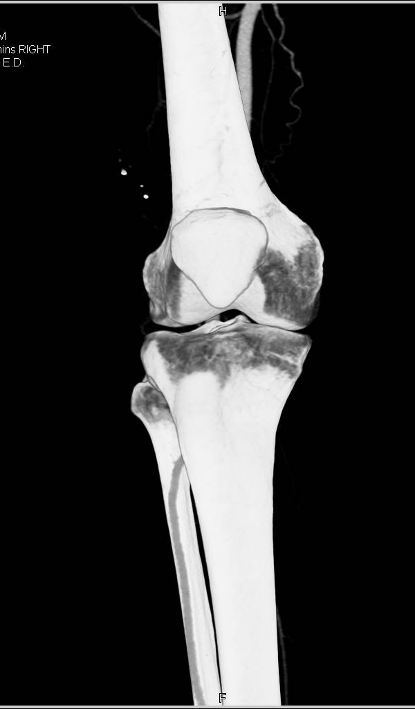 CTA of the Lower Extremity Following GSW Shows no Evidence of Vascular Injury - CTisus CT Scan