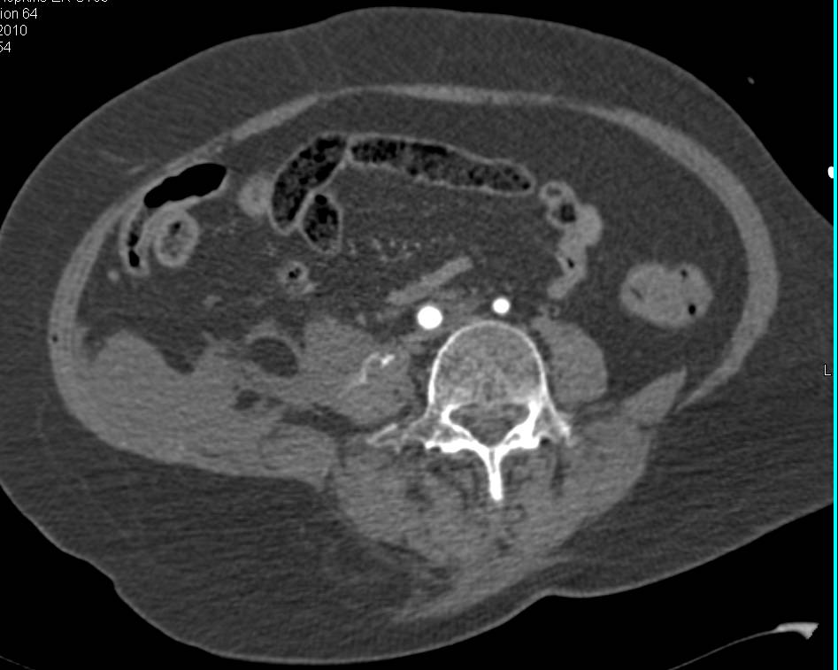 Pelvic Fractures with Active Bleed in the Right Lower Quadrant - CTisus CT Scan