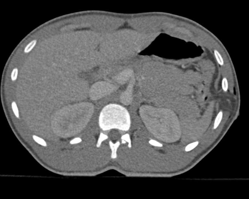 Stabbing Left Flank with Tear of Diaphragm and Herniation of Mesenteric Fat through the Defect - CTisus CT Scan