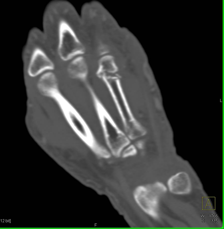 4th Metacarpal Head Fracture - CTisus CT Scan