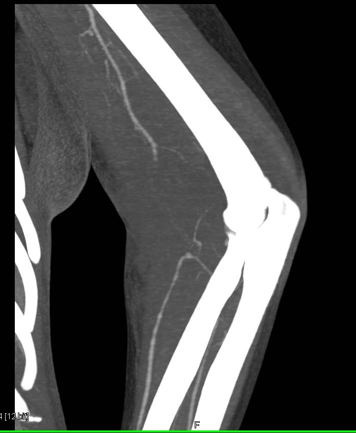 Brachial Artery Injury S/P Trauma with Occlusion - CTisus CT Scan