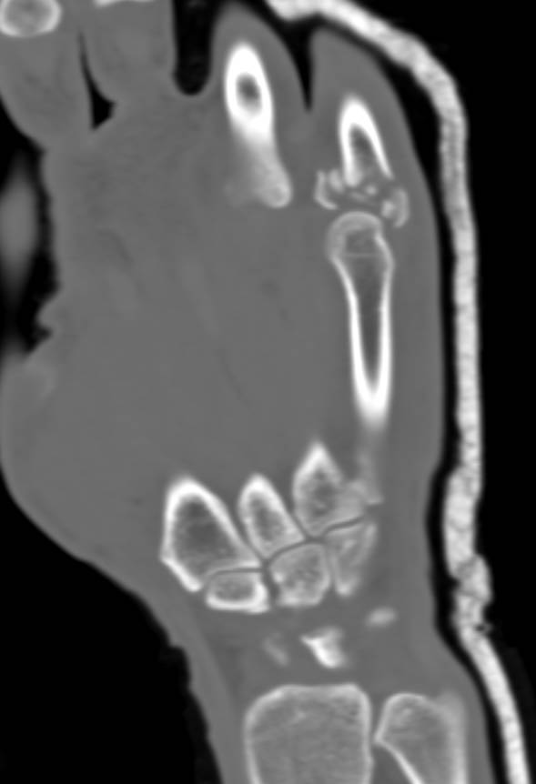 Scapular Fracture and 5th Digit Fracture in 3D - CTisus CT Scan