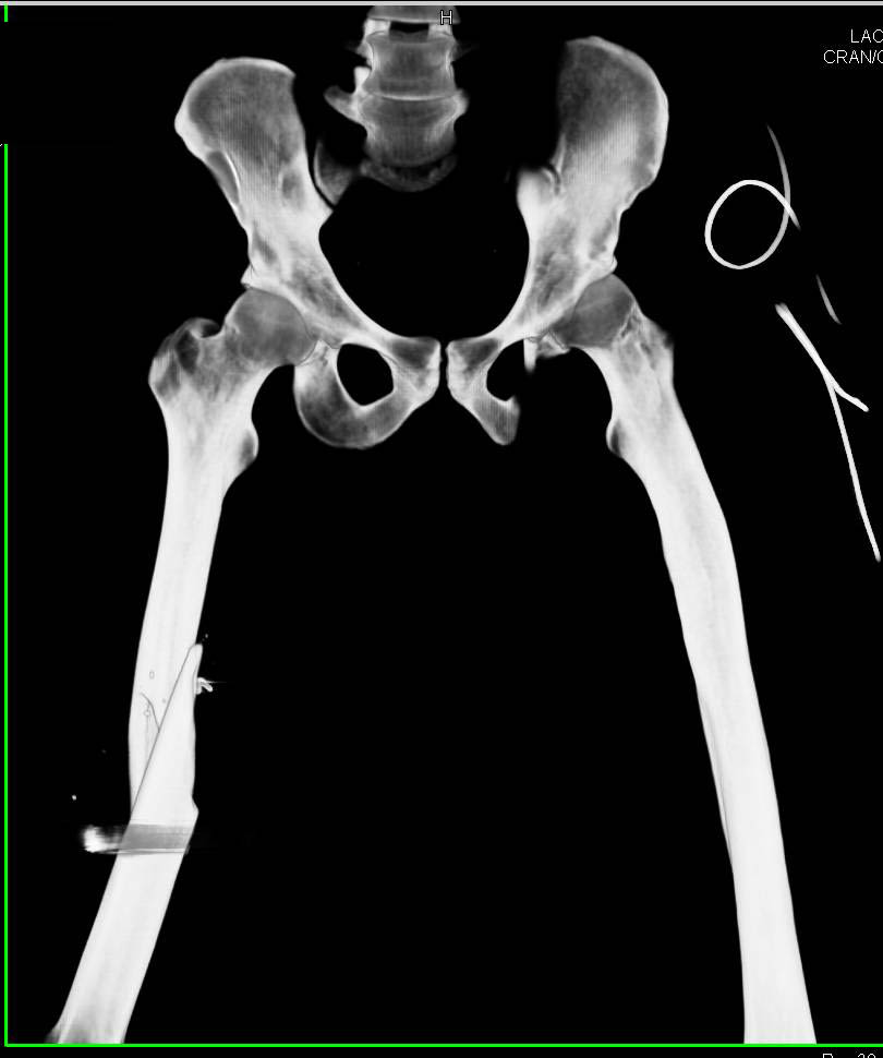 Femur Fracture due to GSW Without Vascular Injury - CTisus CT Scan