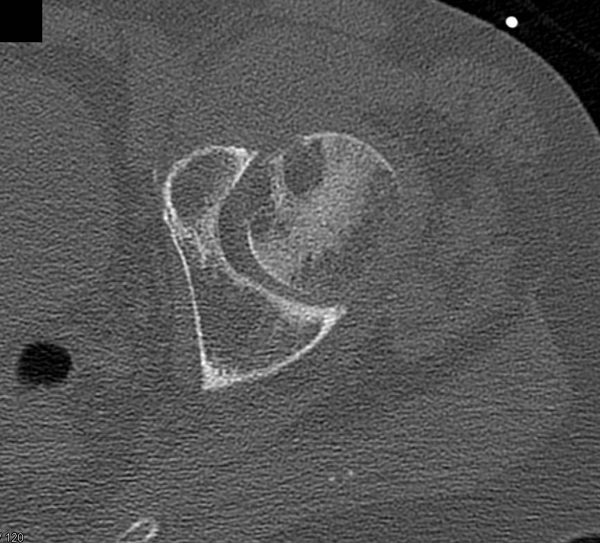 Fracture with Impaction of the Neck of the Femur - CTisus CT Scan