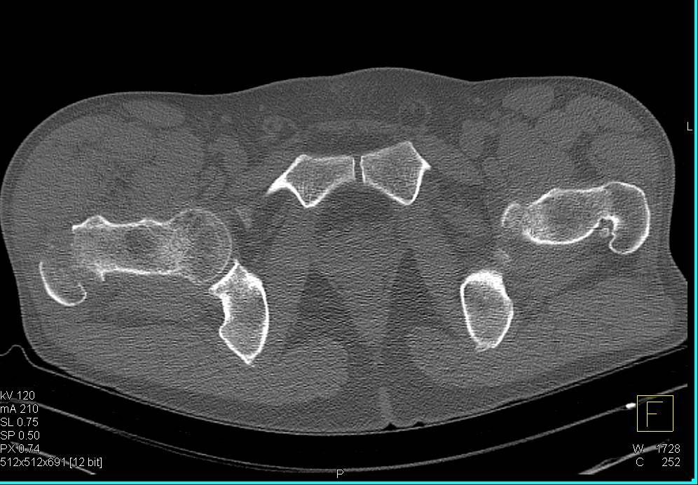 Inter-Trochanteric Fracture Right Femur - Trauma Case Studies - CTisus ...