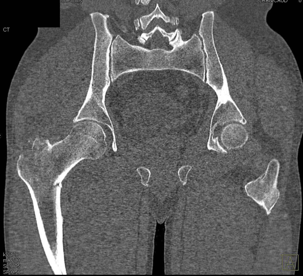 Greater Trochanter Femur Fracture