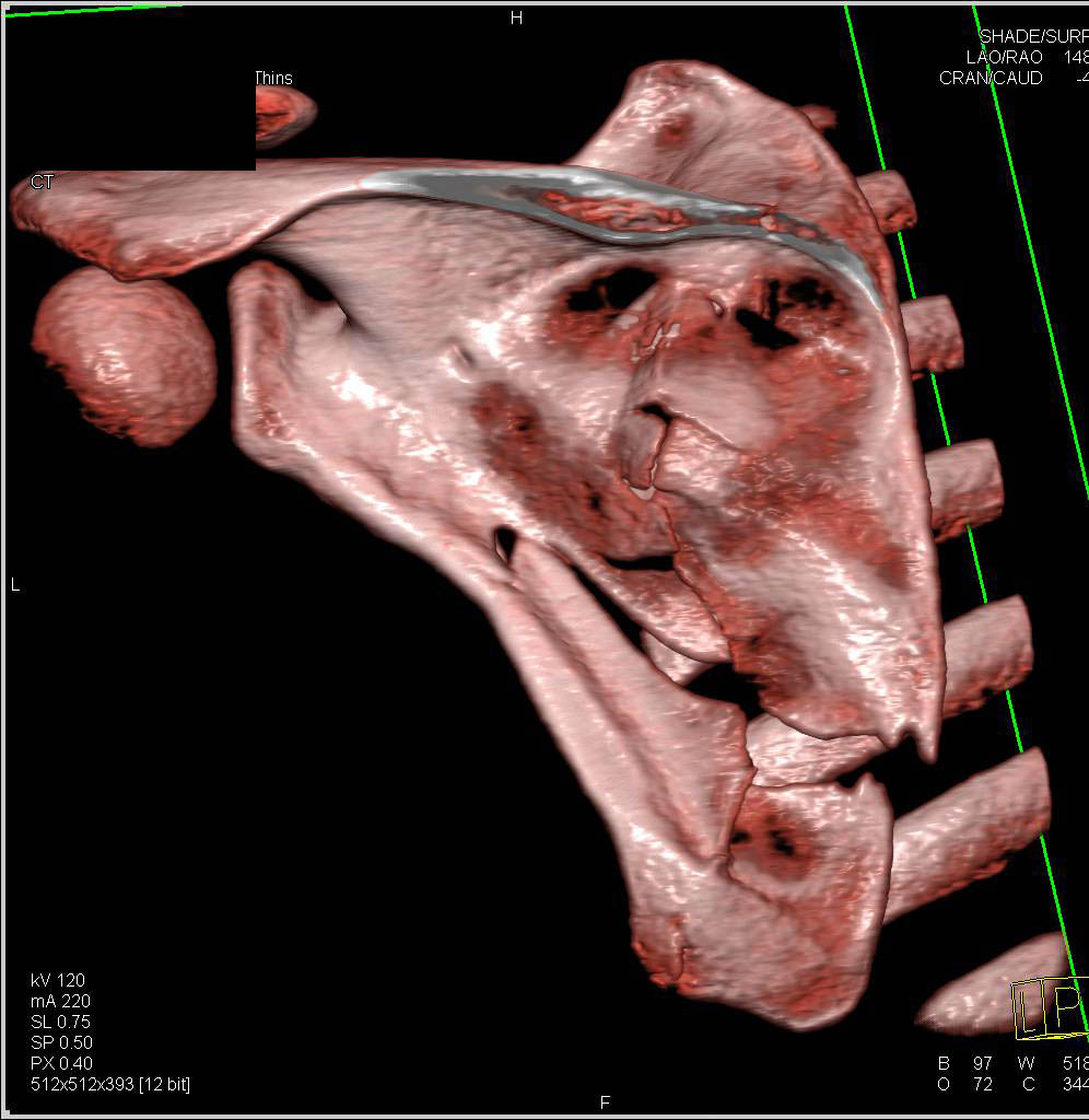 Scapular fracture - CTisus CT Scan