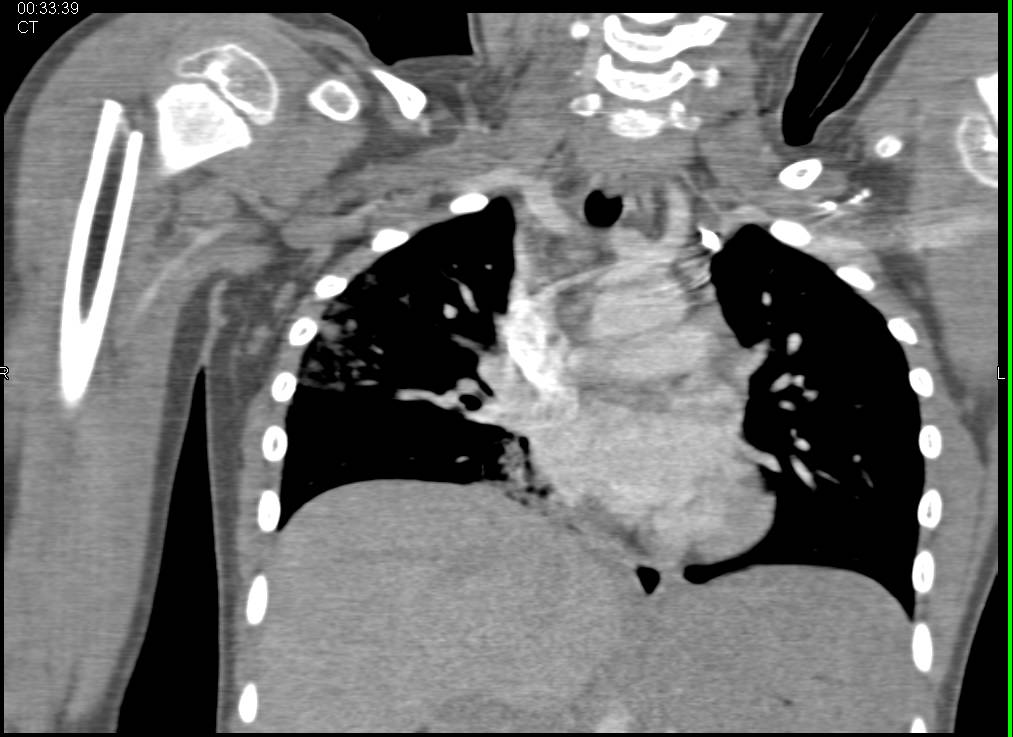 Right Humerus Fracture with Hematoma - CTisus CT Scan