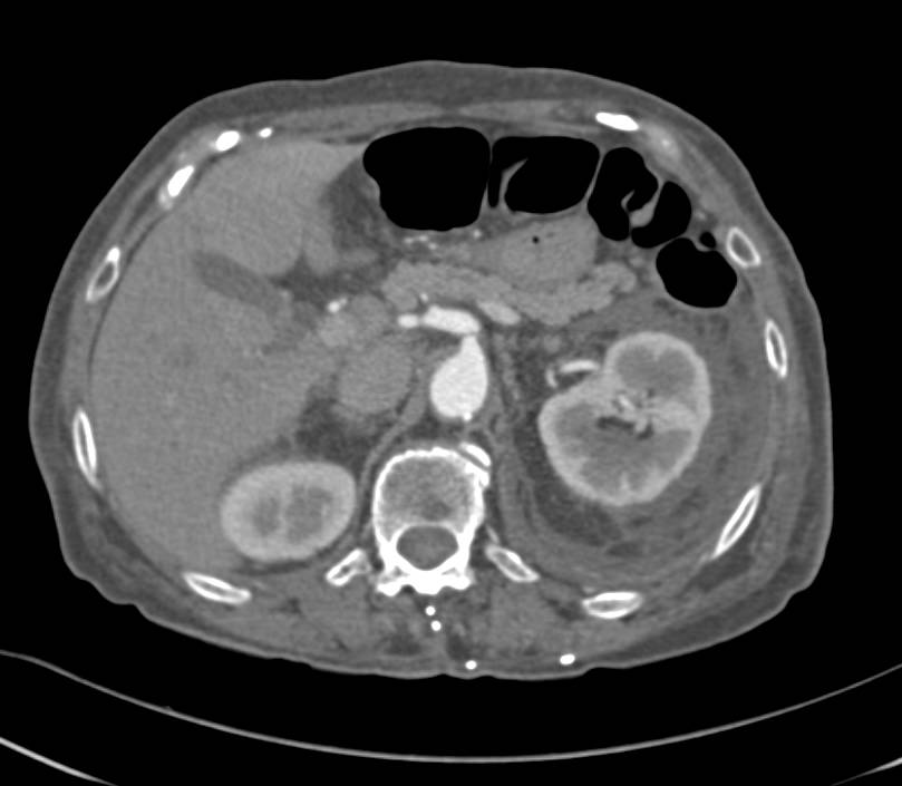 Renal Trauma with Pyelosinus Extravasation Left Kidney - CTisus CT Scan