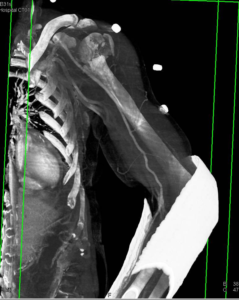 Humerus Fracture Without Vascular Injury - CTisus CT Scan