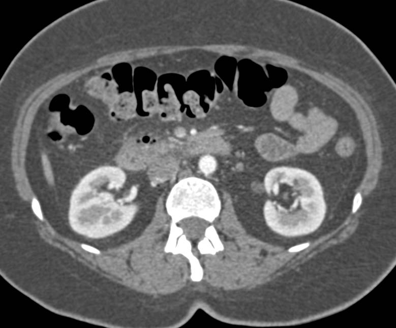 Perforated Duodenum due to Endoscopic Retrograde Cholangiopancreatography (ERCP) with Biopsy. Duodenitis and Pancreatitis also seen - CTisus CT Scan