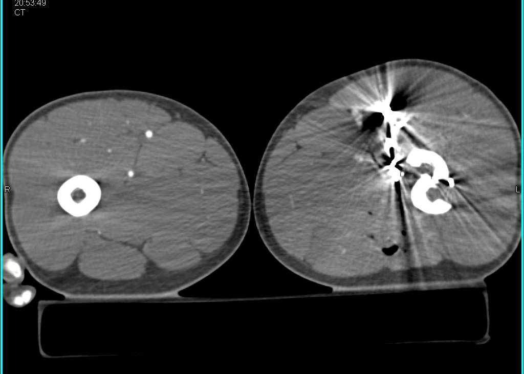 GSW Thigh with Femur Fracture but Intact Superficial Femoral Artery (SFA) - CTisus CT Scan