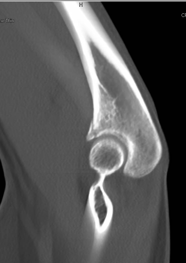 3D Elbow with Olecranon Fracture - CTisus CT Scan