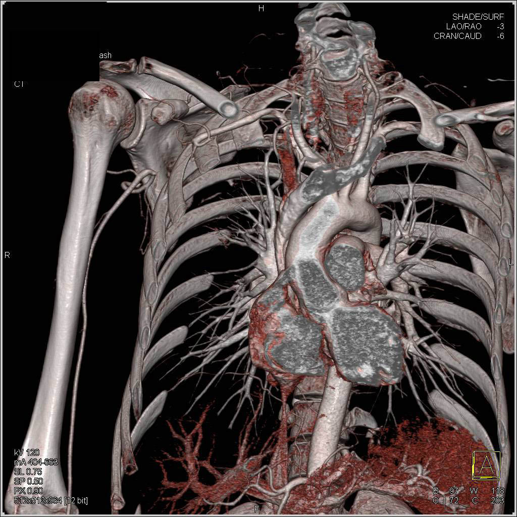 Occluded Right Axillary Artery S/P Trauma - CTisus CT Scan