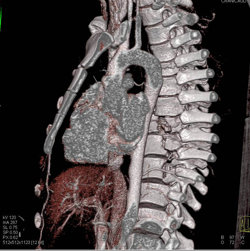 T-Spine Trauma with Fracture/Dislocations and Paraspinal Hematoma - CTisus CT Scan