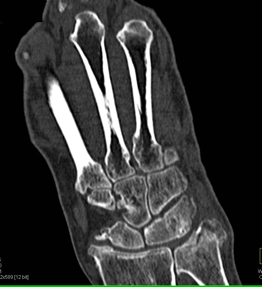 Scaphoid Fracture - CTisus CT Scan