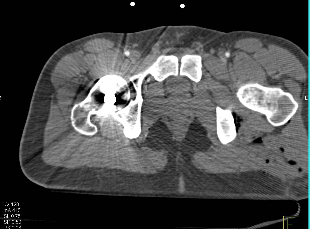 GSW with Renal Laceration and Bone Trauma - CTisus CT Scan