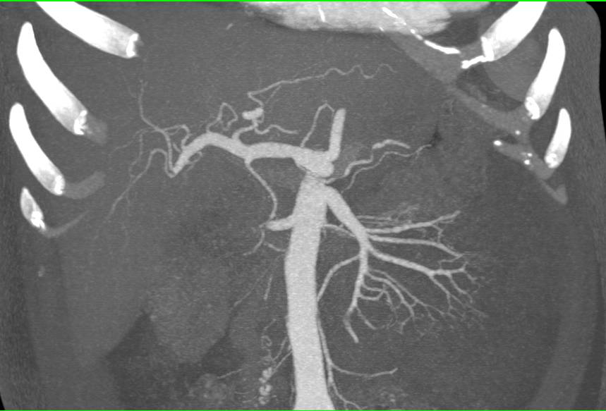 Renal Laceration - CTisus CT Scan