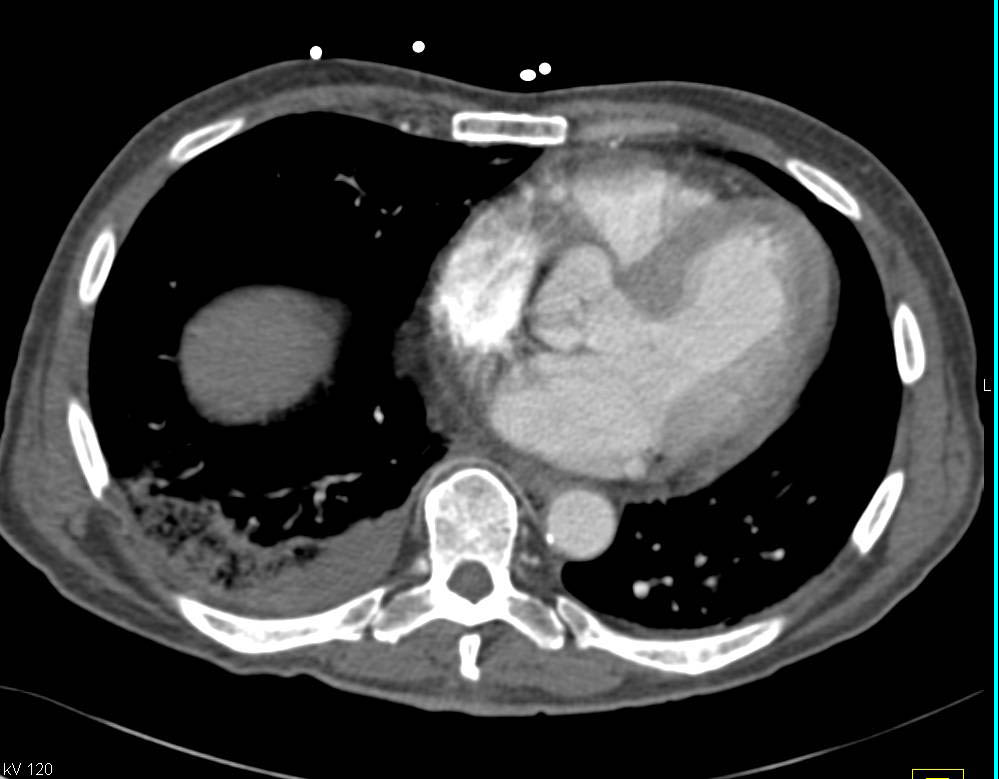 Liver and Renal Laceration - CTisus CT Scan