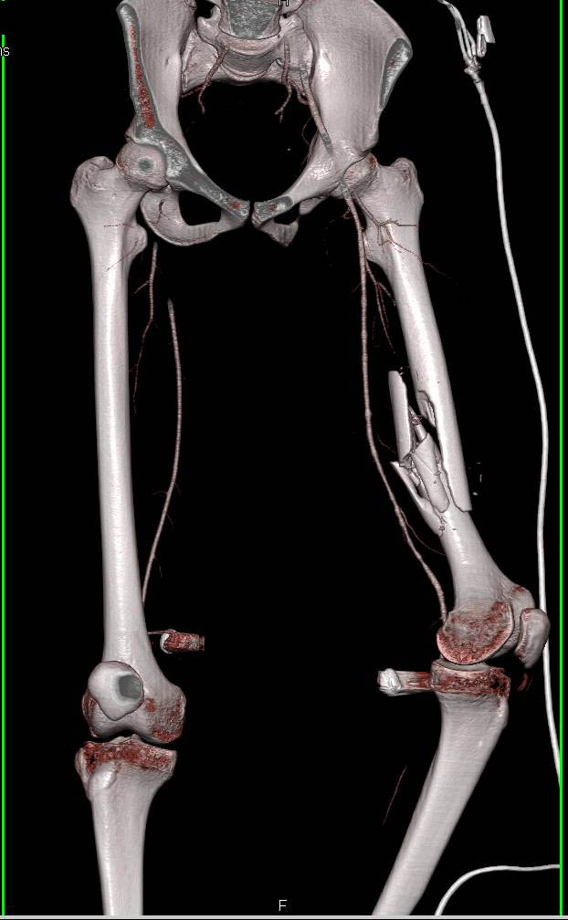 Comminuted Femur Fracture Without Vascular Injury - CTisus CT Scan