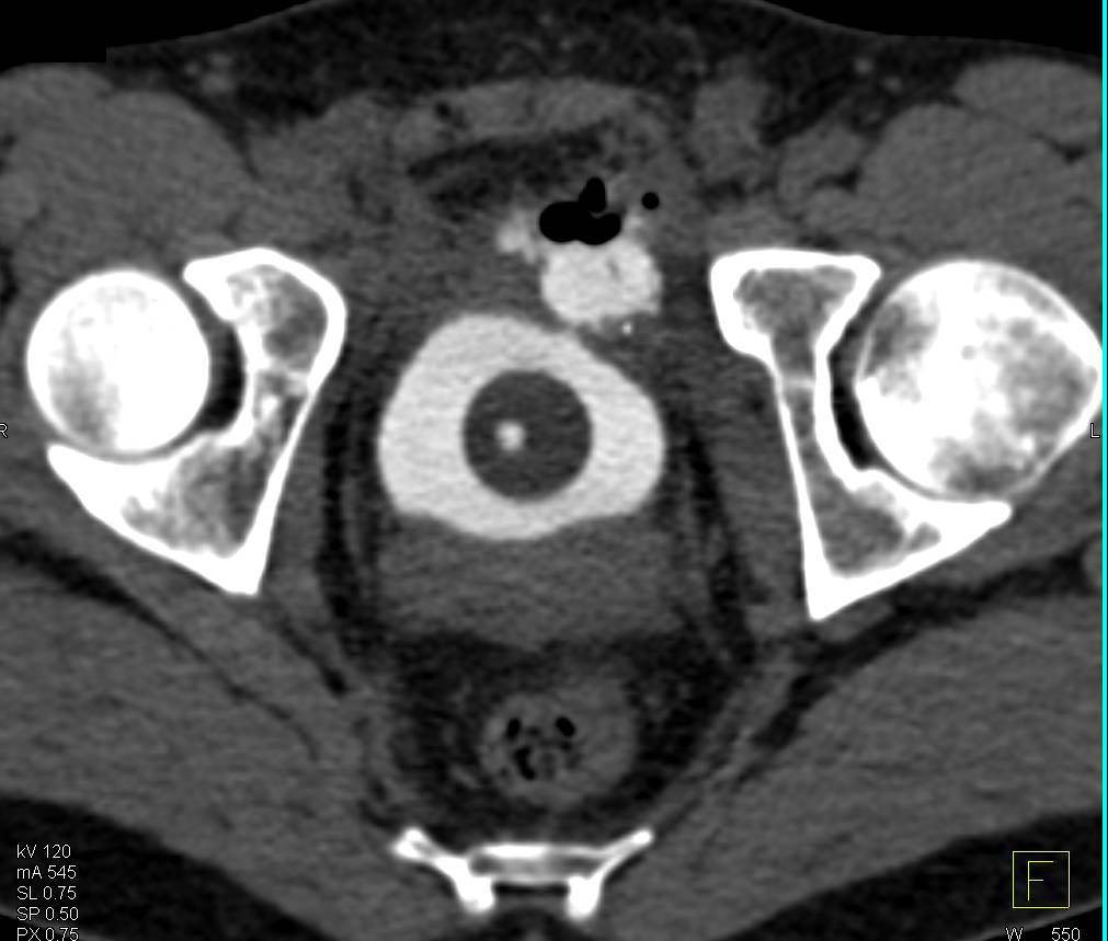 CT Cystogram with Extraperitoneal Contrast Extravasation Following Trauma - CTisus CT Scan