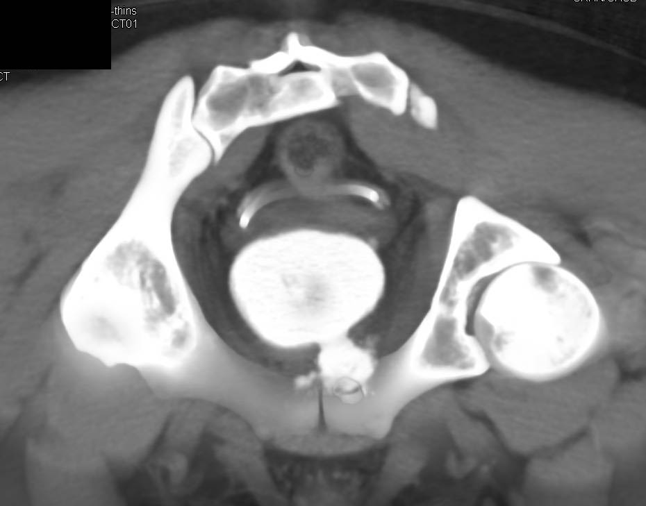 Bladder Trauma with Leak s/p GSW - CTisus CT Scan
