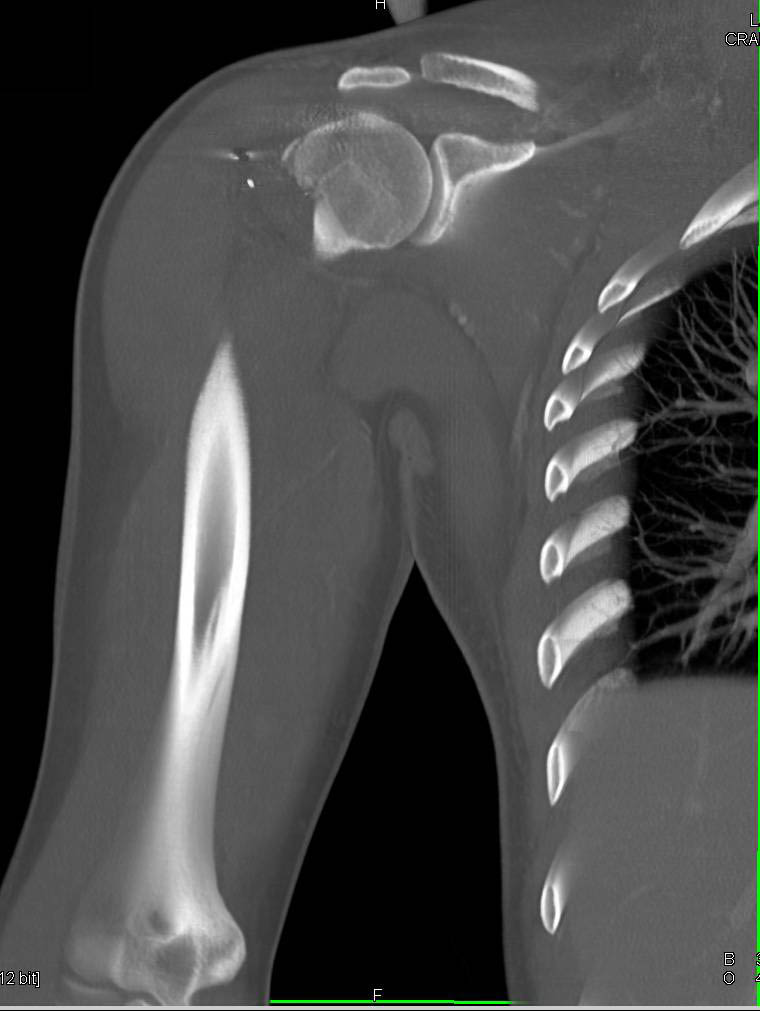 Humerus Fracture due to GSW - CTisus CT Scan