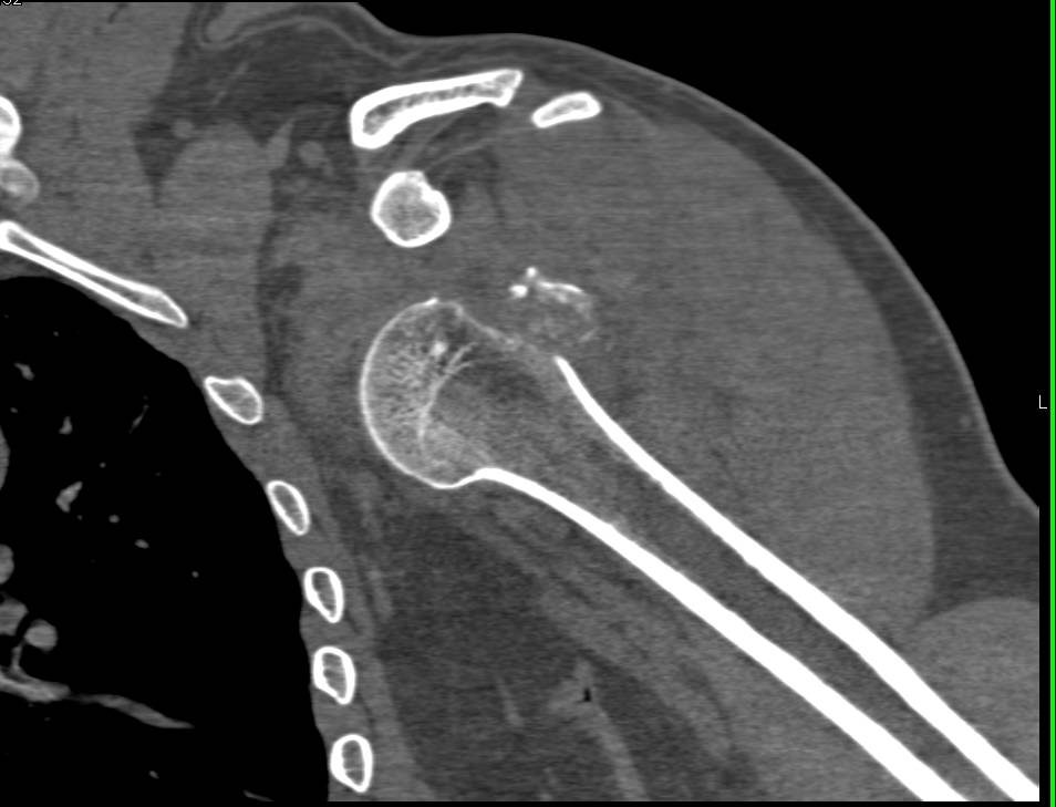 Fracture with Dislocation of the Left Shoulder - CTisus CT Scan
