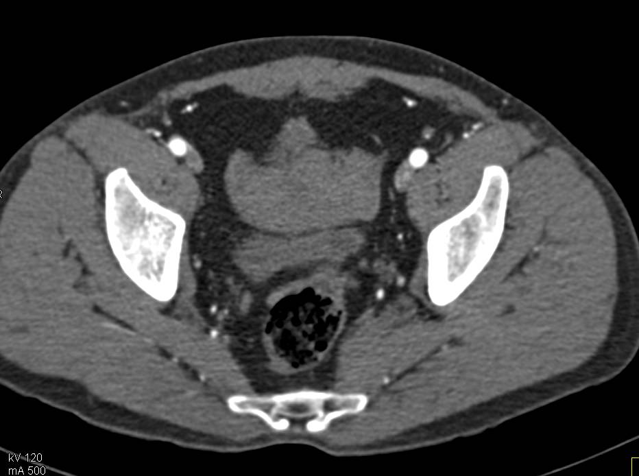 Active Bleed from Mesenteric Artery s/p Trauma - CTisus CT Scan