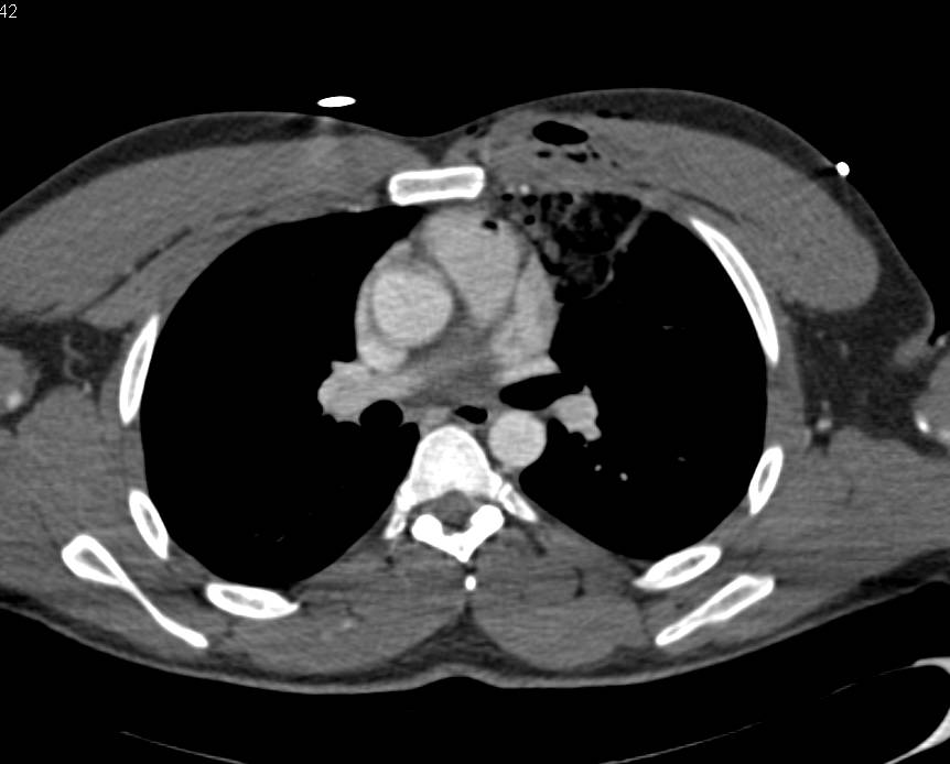 Pulmonary Trauma with Pulmonary Hemorrhage - CTisus CT Scan