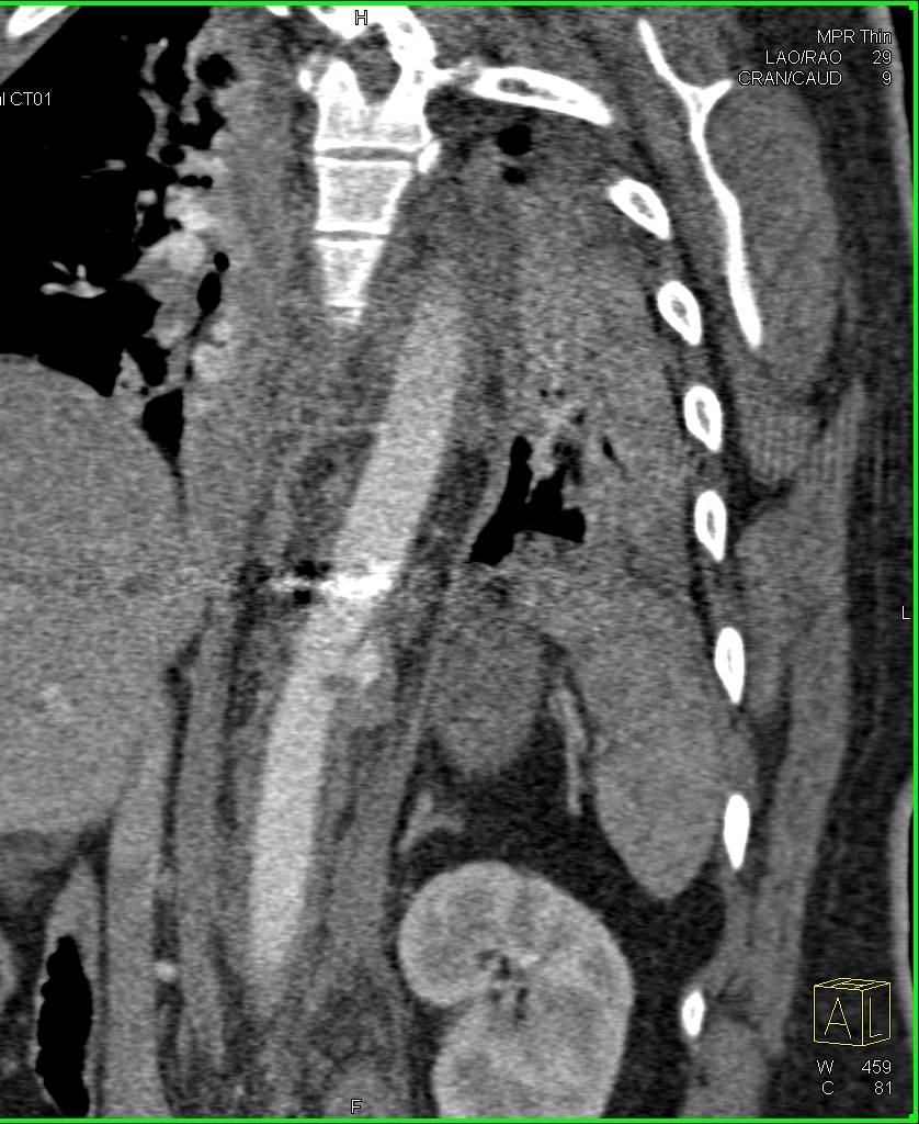 Aortic Laceration with Hematoma Following Gun Shot Wound with Associated Spinal Injury - CTisus CT Scan