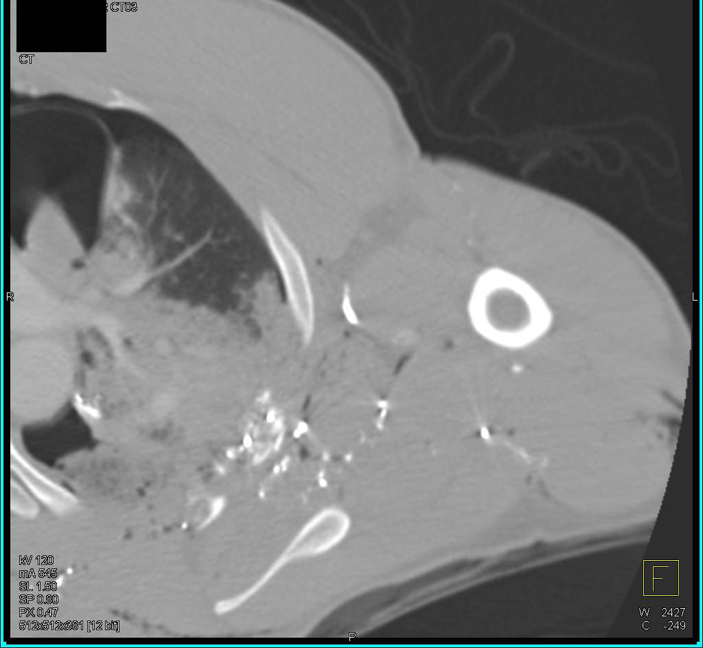 Pulmonary Hemorrhage and Rib Fractures Following a GSW - CTisus CT Scan