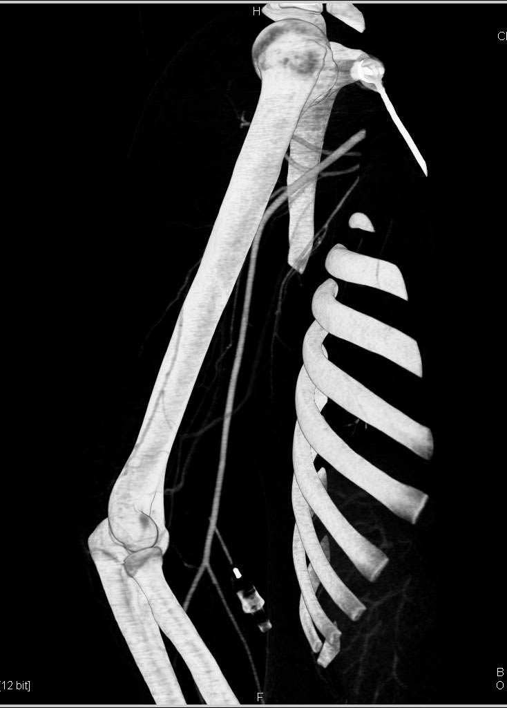 Normal CTA of Axillary-Brachial-Radial Arteries - CTisus CT Scan