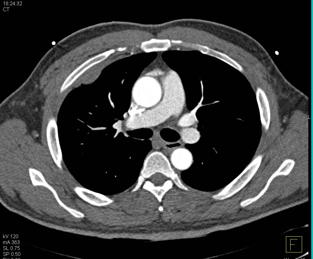 Stab Wound Right Chest with Active Bleed in Chest Wall and Lung Contusion as well - CTisus CT Scan