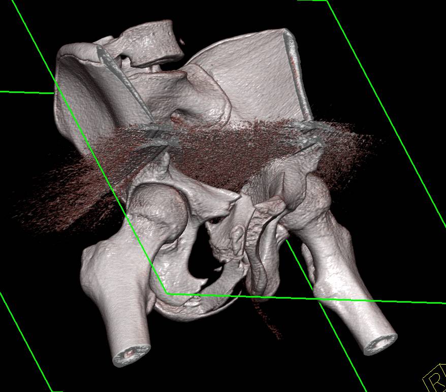 Complex Right Acetabular Fractures in 3D - CTisus CT Scan