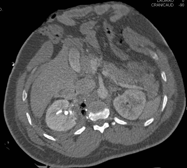 GSW and Contrast Extravasation Right Kidney - CTisus CT Scan