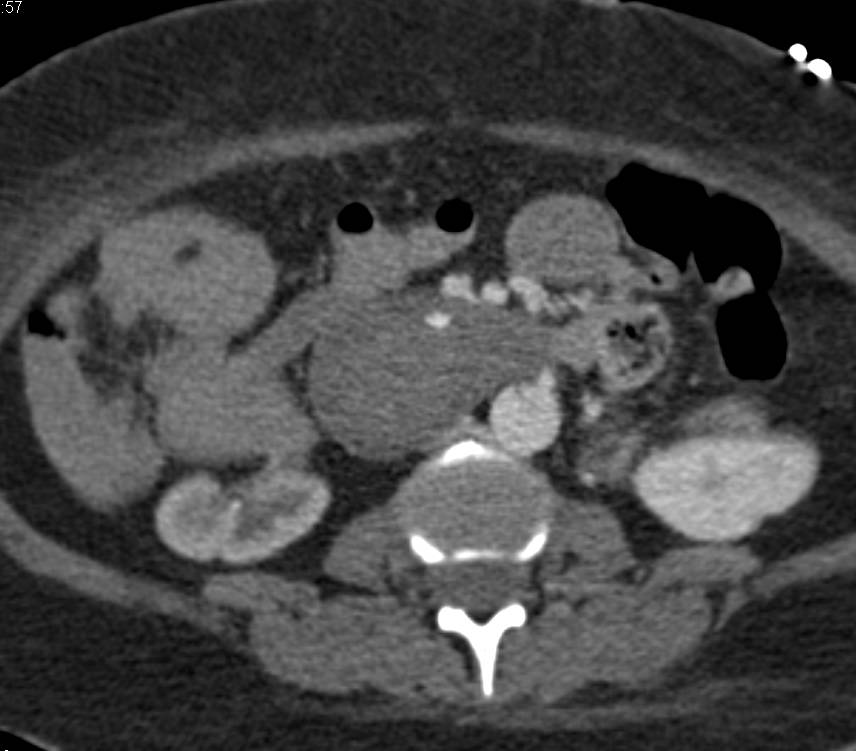 Bleed in Duodenum s/p Trauma - CTisus CT Scan