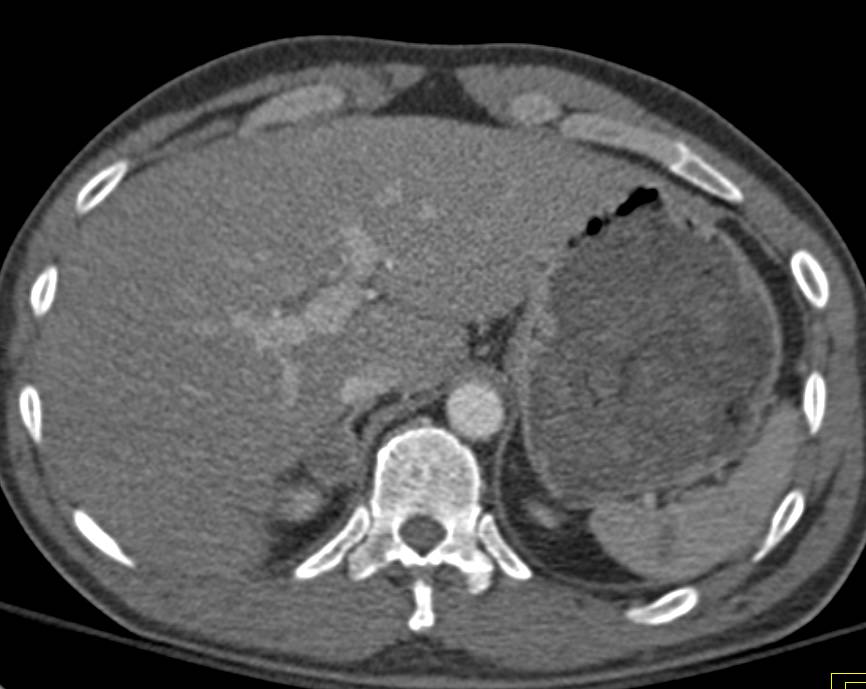 Sacral and Iliac Fractures - CTisus CT Scan