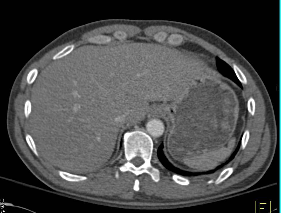 Ring Fracture in Pelvis with Diastasis of the Symphysis Pubis and the Sacroiliac Joint (SI Joint) - CTisus CT Scan