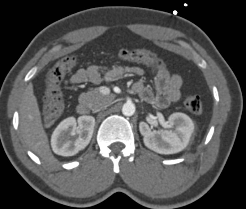 GSW with Renal Laceration but No Colon Injury - CTisus CT Scan