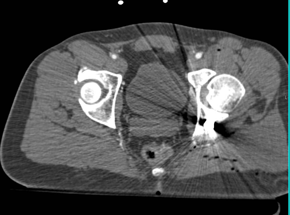 GSW with Renal Laceration and Acetabular Fracture - CTisus CT Scan