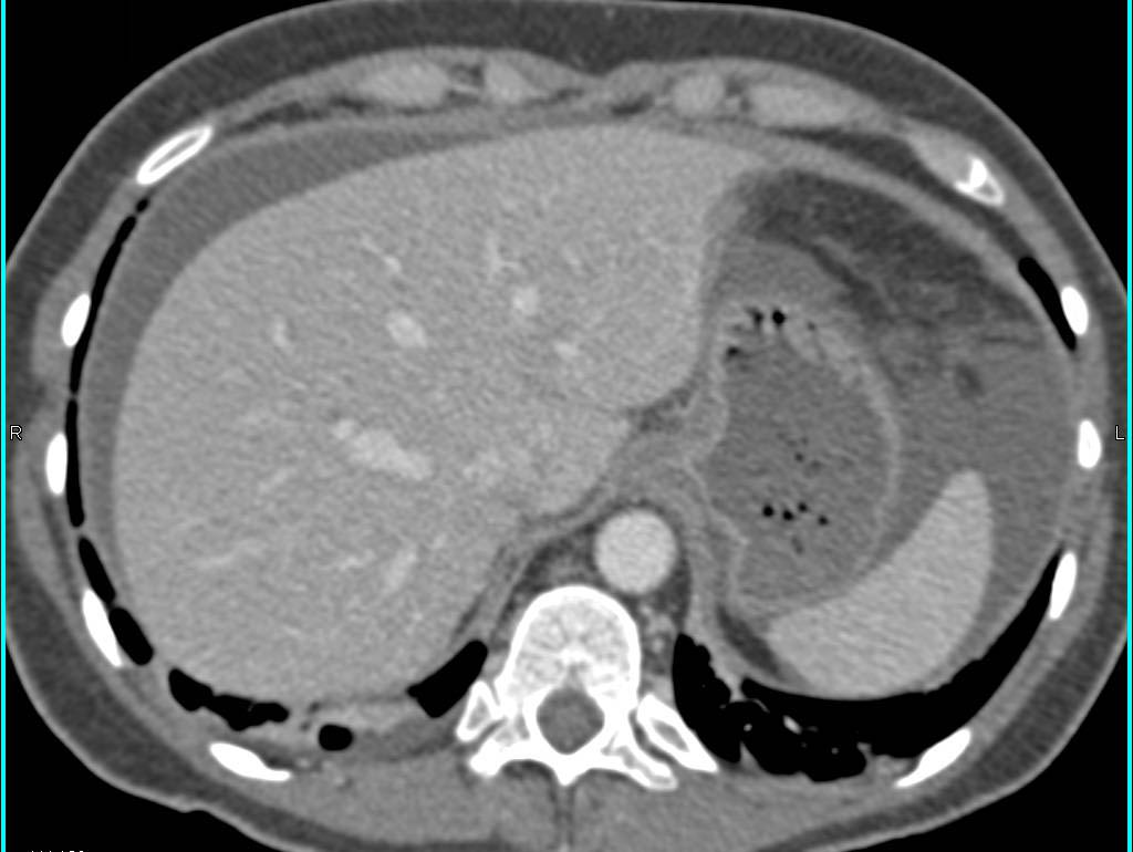 Subtle Splenic Laceration with Hemoperitoneum - CTisus CT Scan