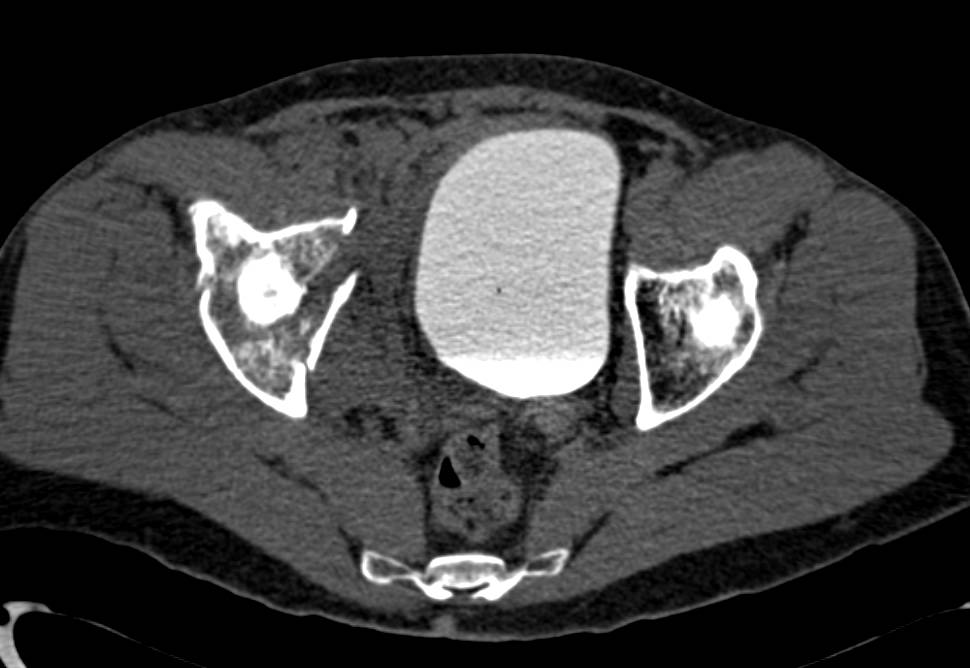 Acetabular Fractures with Pelvic Hematoma but Normal CT Cystogram - CTisus CT Scan