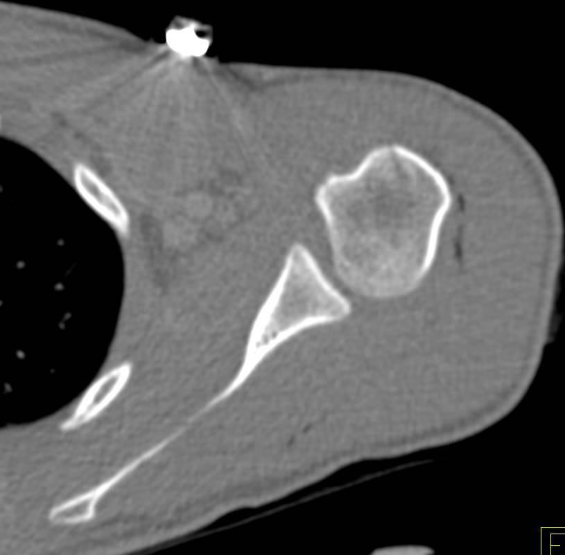 Gunshot Wound Shoulder Without Fracture - CTisus CT Scan