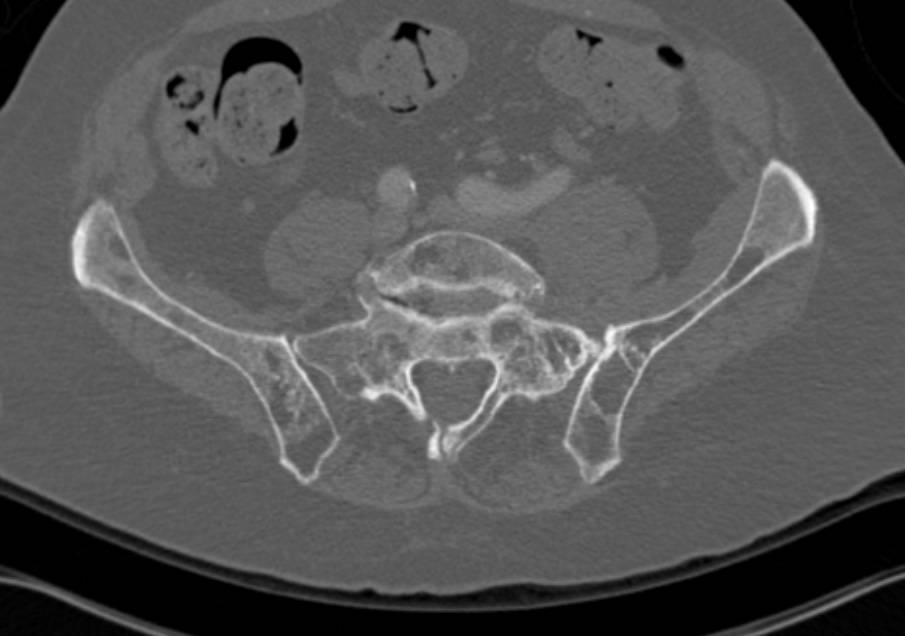 Left Sided Sacral Stress Fracture - CTisus CT Scan